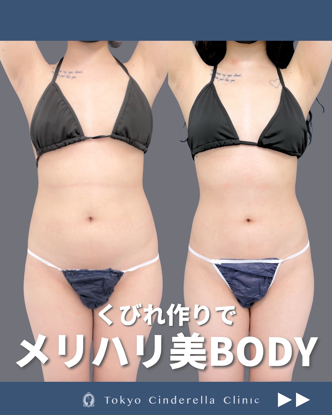 新宿院で行ったお腹とウエストと腰のアキーセル脂肪吸引の6ヶ月後の症例写真