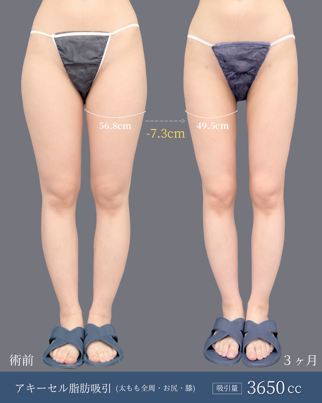 新宿院で行った太ももとお尻と膝のアキーセル脂肪吸引の名医の吉原伯医師の3ヵ月後の症例写真