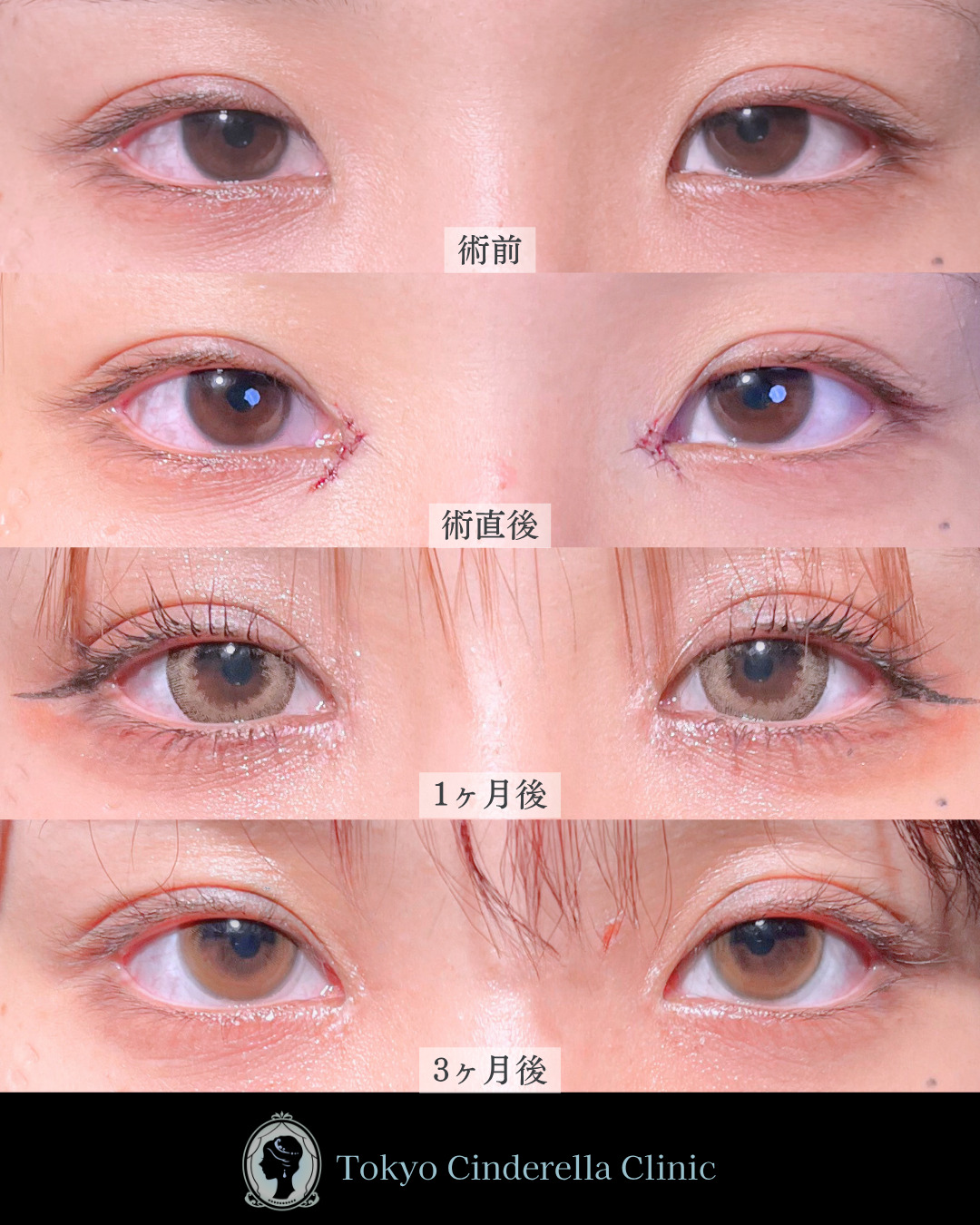 池袋院で行ったMD式目頭切開整形で有名な名医の石井達也の症例写真