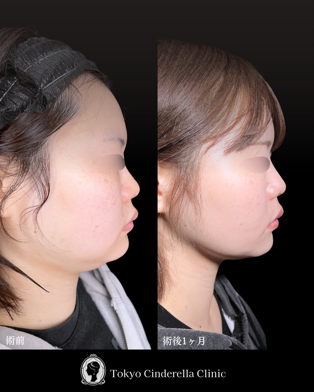 池袋院で行った小顔脂肪吸引(頬・あご下・エラ下)/クイックリフト 10本整形で有名な名医の石井達也の症例写真