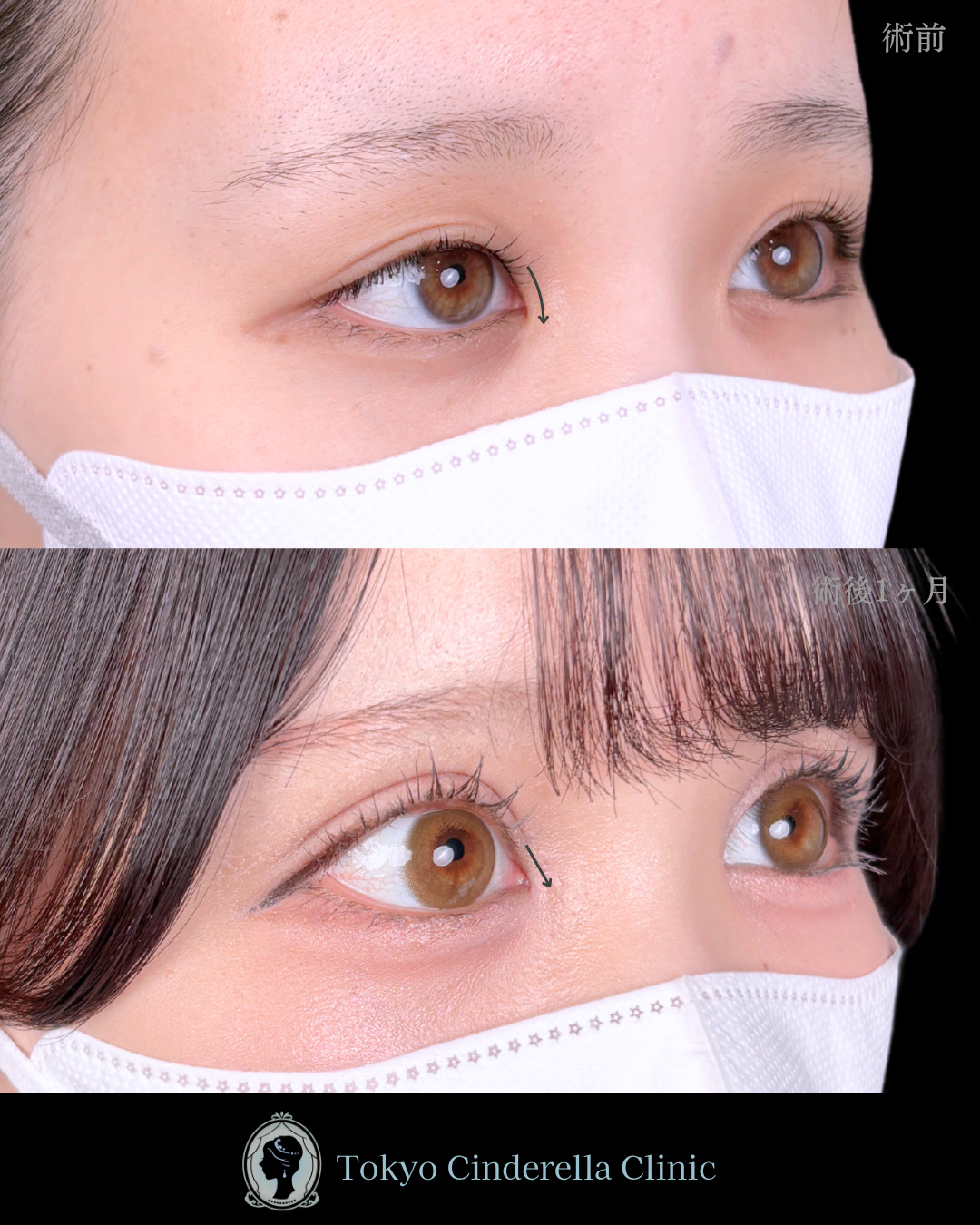 池袋院で行った二重埋没法とMD式目頭切開整形で有名な名医の石井達也の症例写真