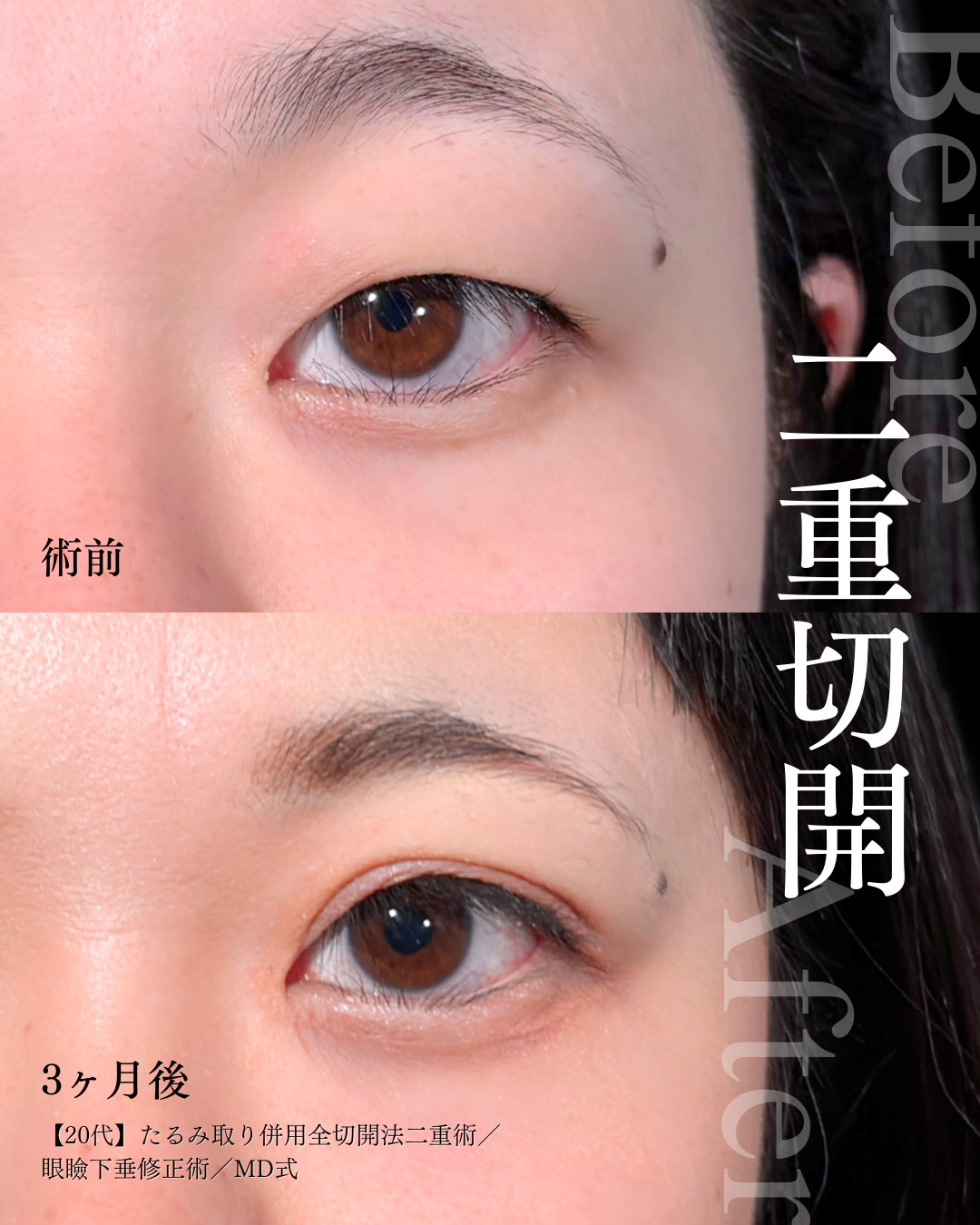 大宮院で行った二重切開と眼瞼下垂手術の3ヶ月後の症例写真