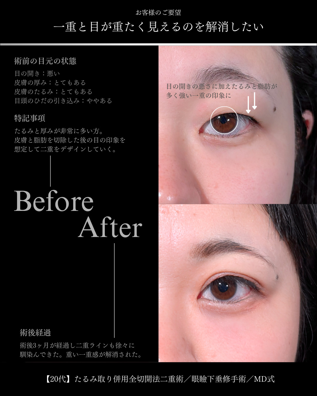 大宮院で行った二重切開と眼瞼下垂手術の3ヶ月後の症例写真