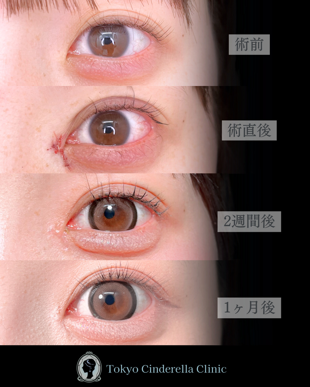 池袋院で行ったクイックシンデレラ・ダブルとMD式目頭切開整形で有名な名医の石井達也の症例写真
