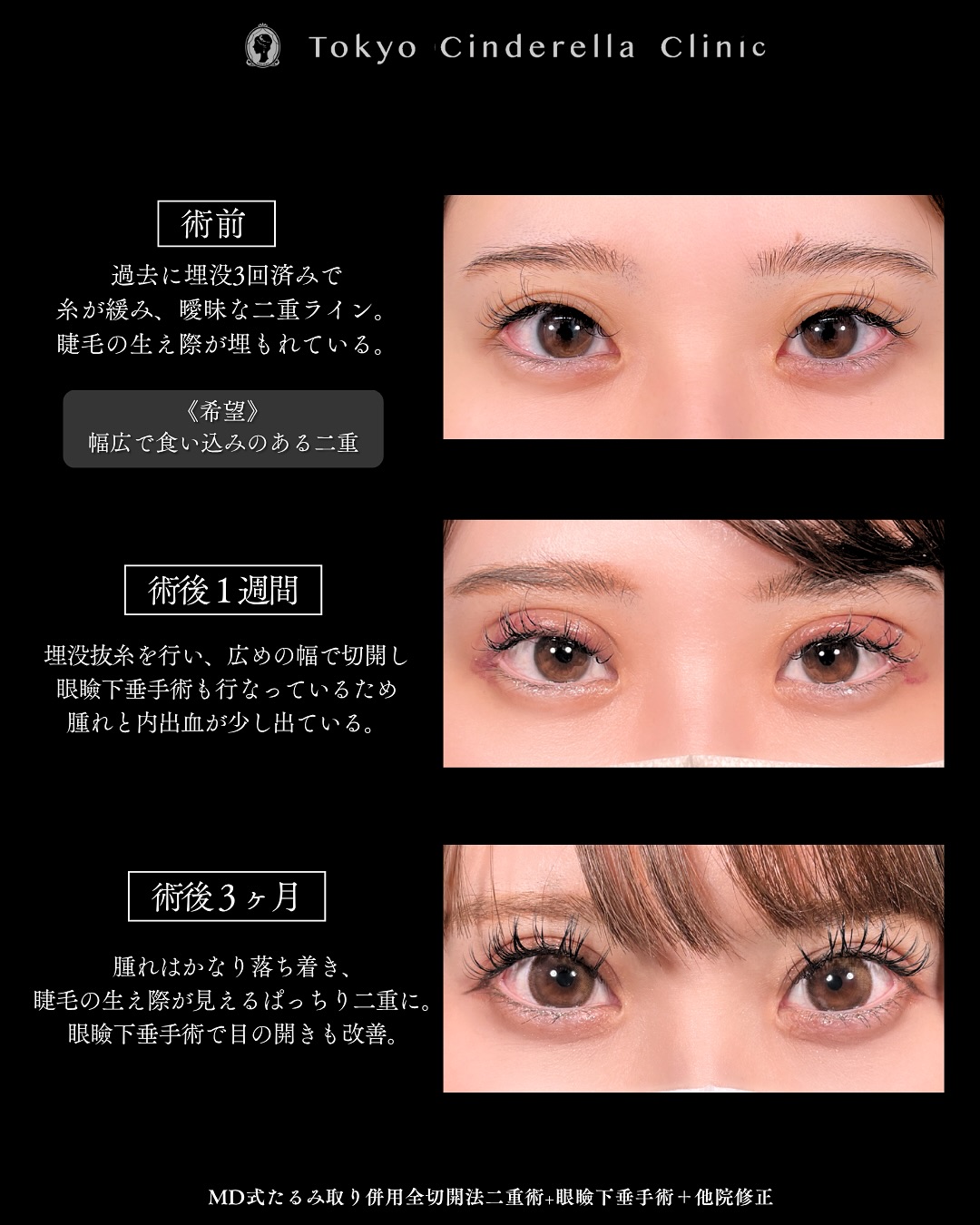 新宿院で行った二重整形で有名な吉原伯医師のMD式のたるみ取り併用全切開法二重術と眼瞼下垂手術と他院修正の3ヵ月までのダウンタイム症例写真