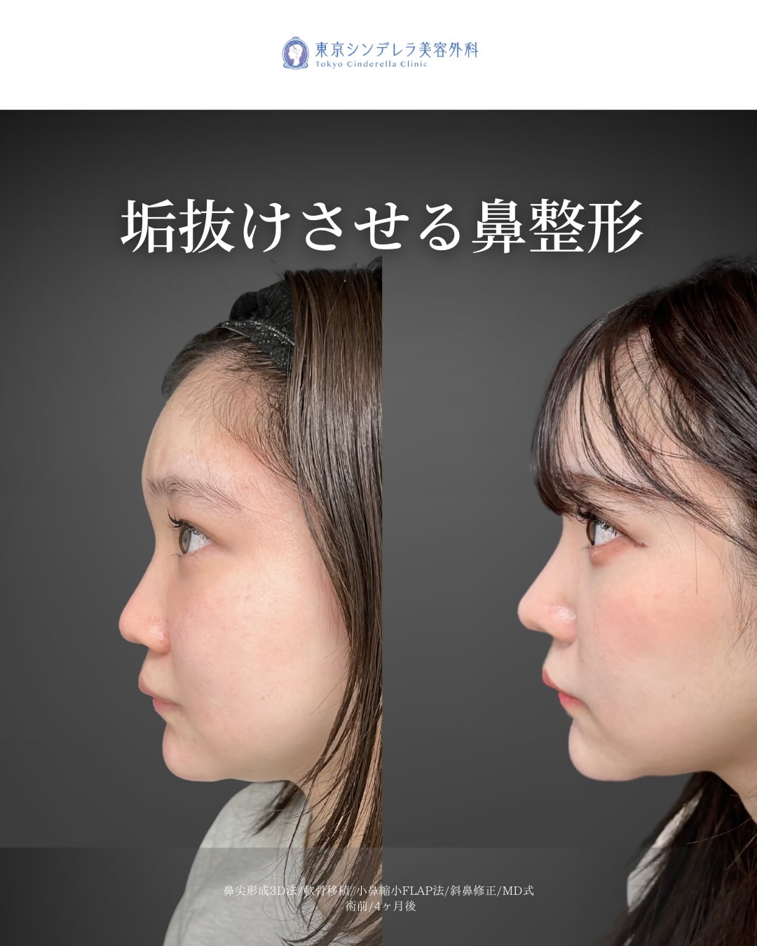 新宿院で行ったMD式の鼻尖形成3D法と軟骨移植と斜鼻修正と小鼻縮小FLAP法の4ヵ月後の症例写真