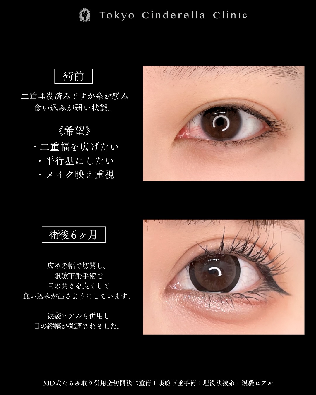 新宿院で行った二重整形で有名な吉原伯医師のMD式のたるみ取り併用全切開法二重術と眼瞼下垂手術と涙袋ヒアルロン酸注入の６ヶ月後の症例写真