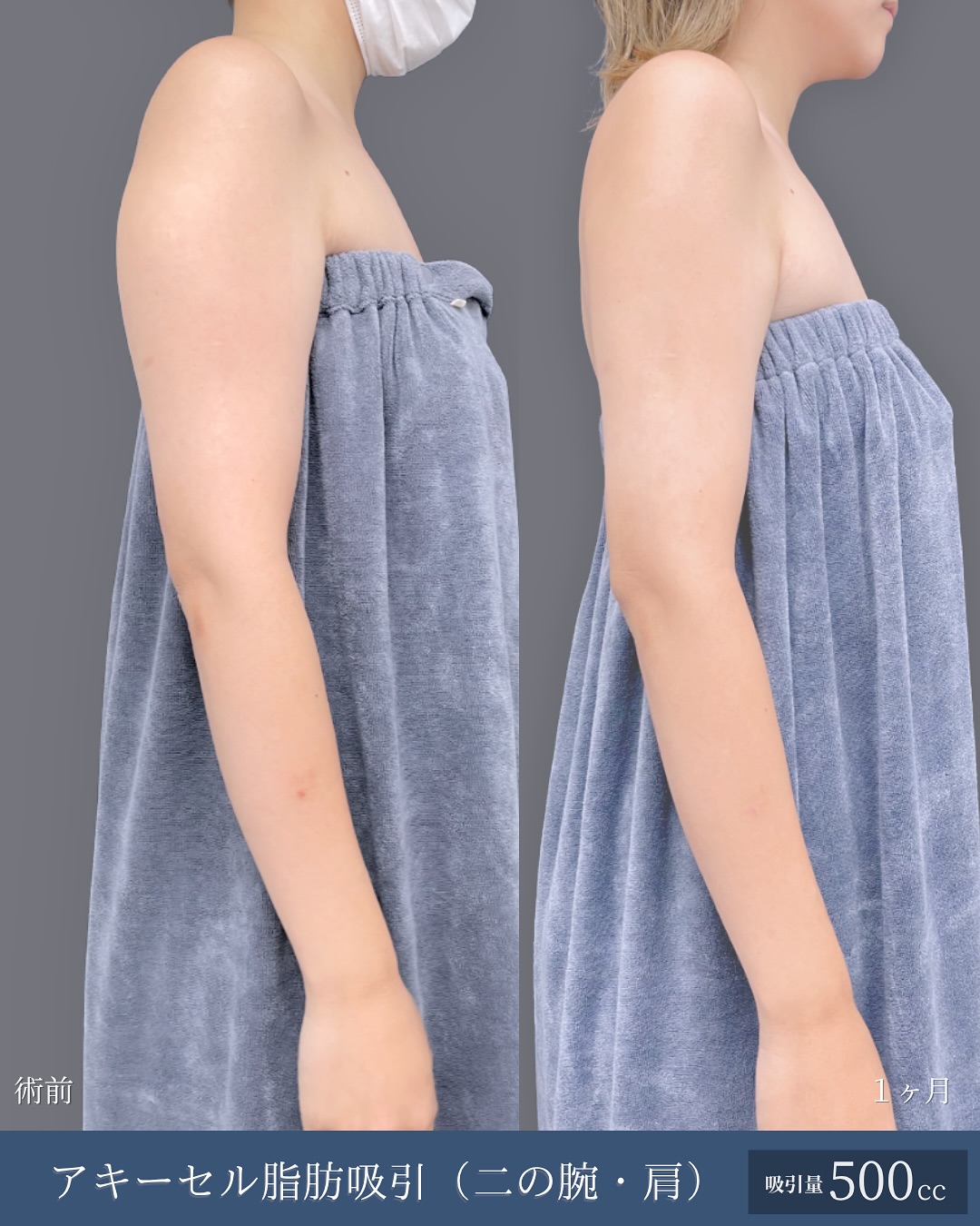 新宿院で行った二の腕と肩のアキーセル脂肪吸引の名医の吉原伯医師の症例写真