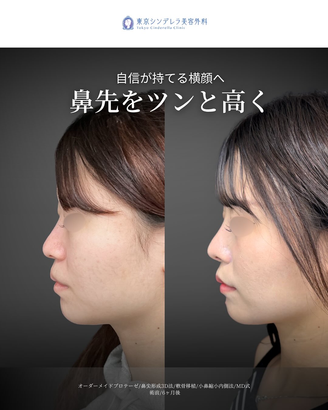 新宿院で行ったMD式鼻尖形成3D法と軟骨移植とオーダーメイドプロテーゼと小鼻縮小内側締め付け法の6ヵ月後の症例写真
