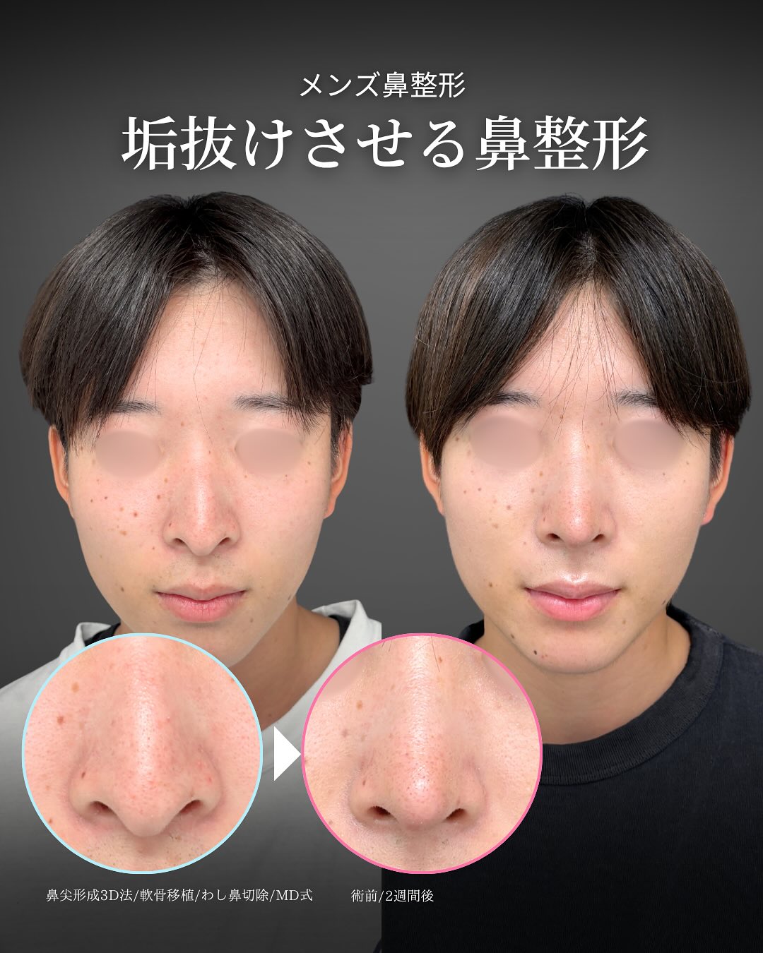 新宿院で行った鼻整形で有名な吉原伯医師のMD式の鼻尖形成3D法と軟骨移植とわし鼻切除の2週間後の症例写真