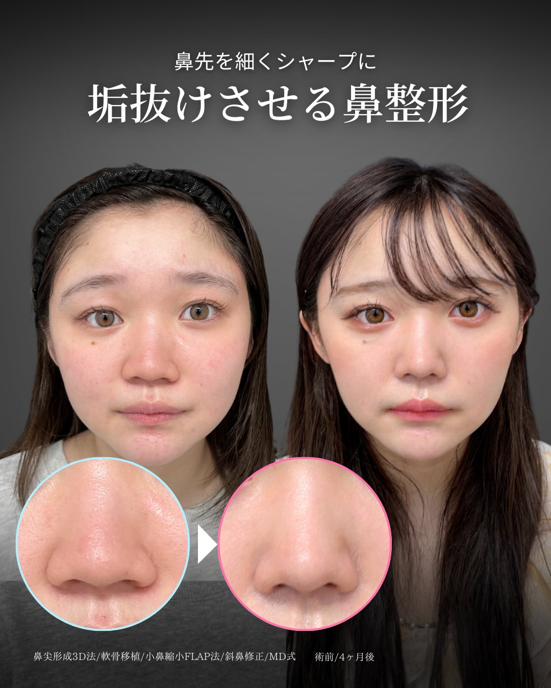 新宿院で行ったMD式の鼻尖形成3D法と軟骨移植と斜鼻修正と小鼻縮小FLAP法の4ヵ月後の症例写真