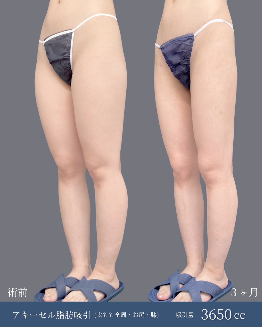 新宿院で行った太ももとお尻と膝のアキーセル脂肪吸引の3ヶ月後の症例写真