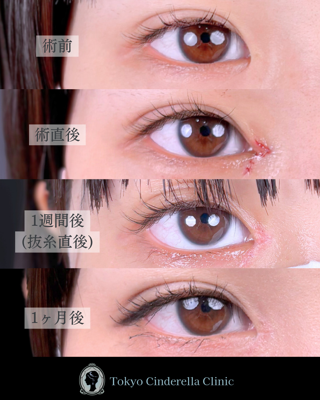 池袋院で行ったMD式目頭切開整形で有名な名医の石井達也の症例写真