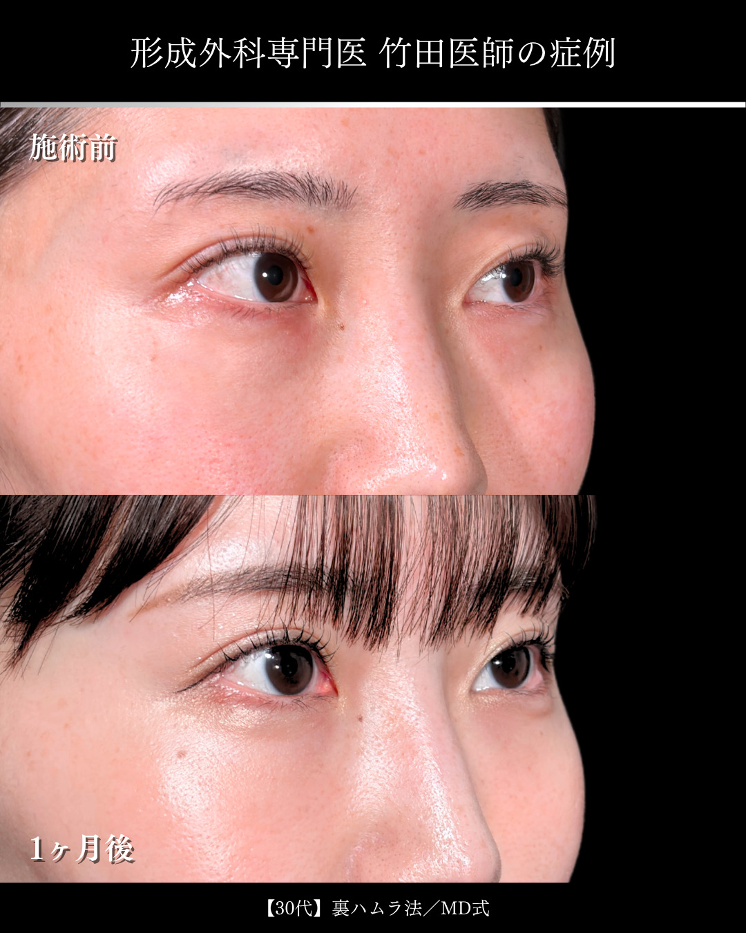 大宮院で行ったクマ取りで有名な竹田昌平医師の裏ハムラ法の症例写真