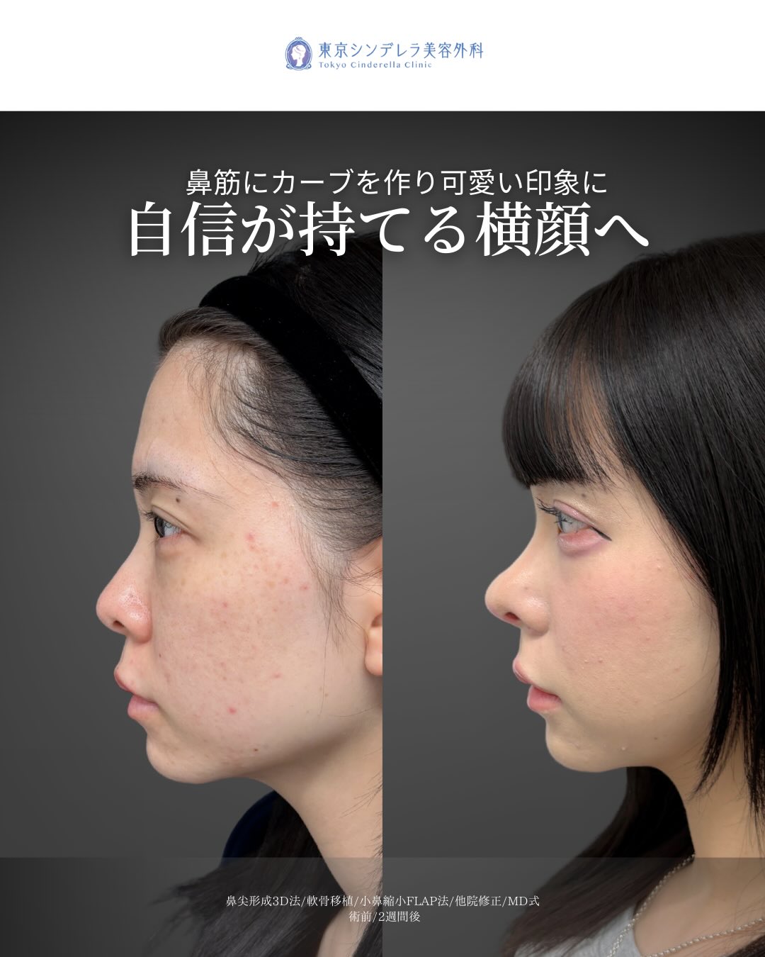 新宿院で行った鼻尖形成3D法と軟骨移植と小鼻縮小FLAP法と他院修正の2週間後の症例写真