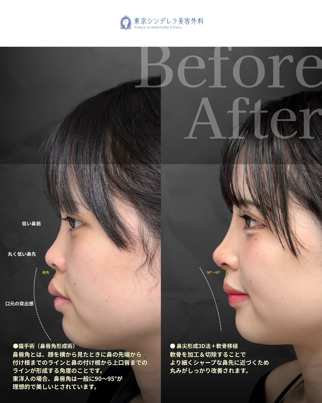 新宿院で行った鼻尖形成3D法と軟骨移植と鼻中隔延長と小鼻縮小内側締め付け法と鼻柱下降術と猫手術の鼻フル整形を行い口元の突出感が改善された2週間後の症例写真