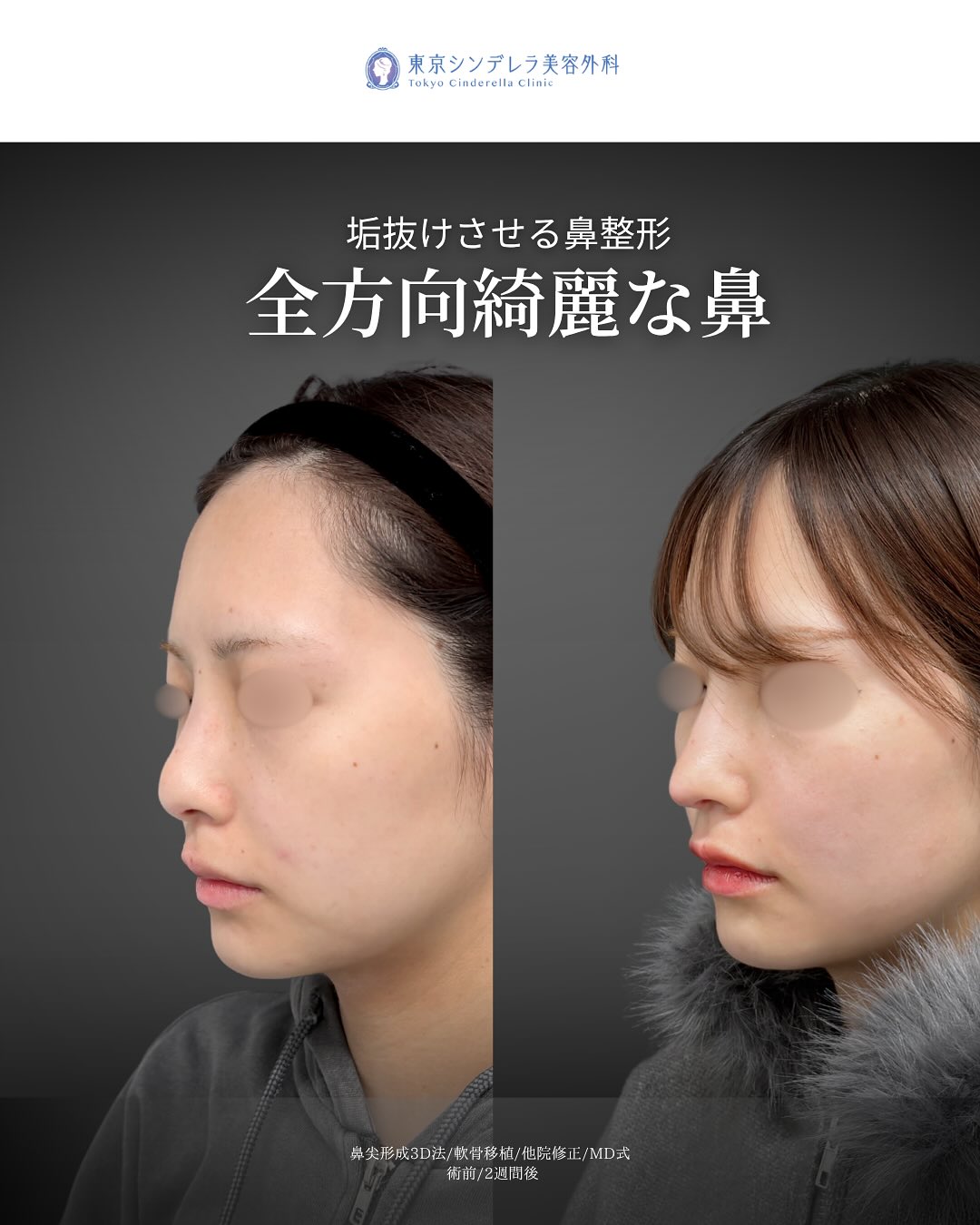 新宿院で行った鼻尖形成3D法と軟骨移植の2週間後の症例写真