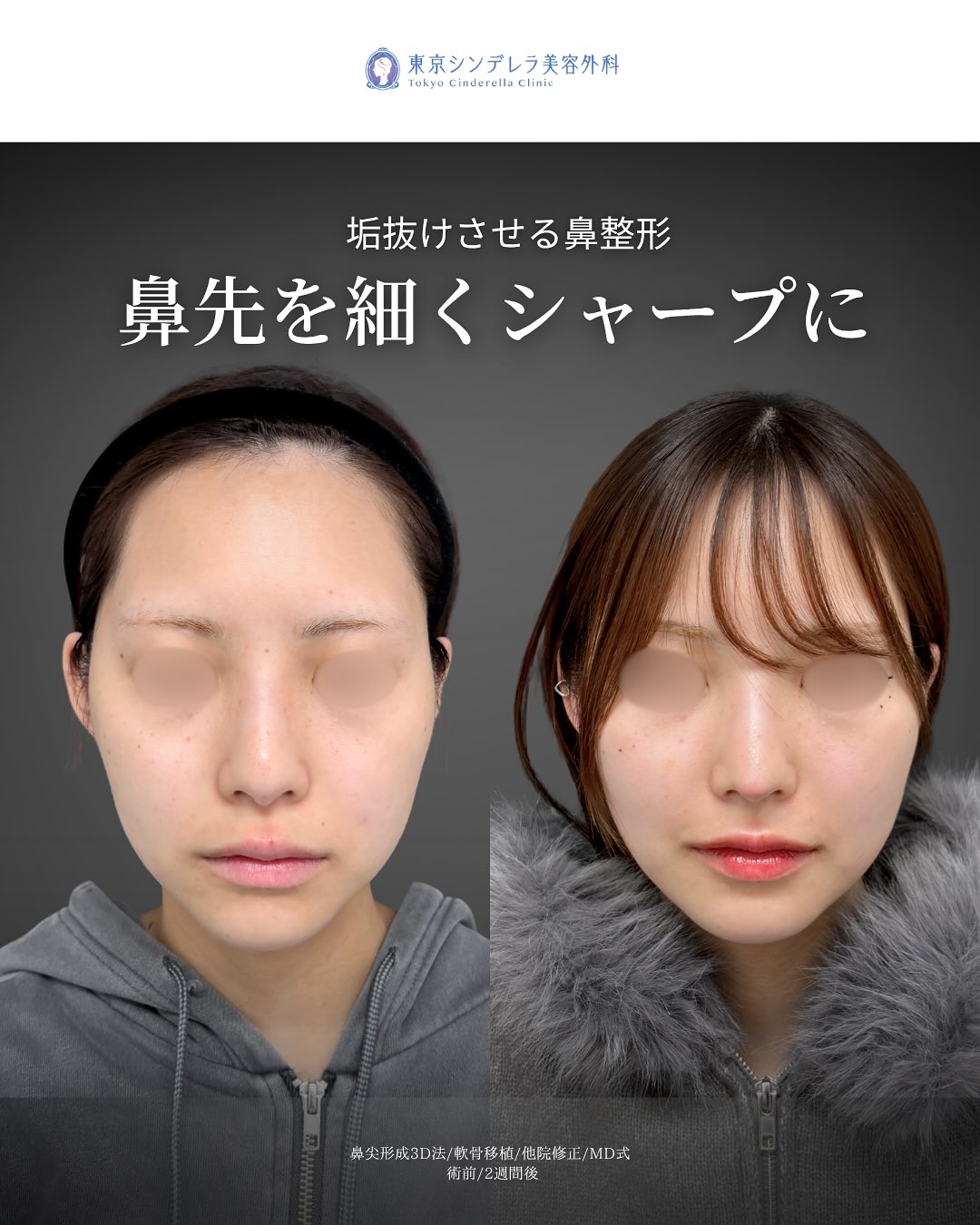 新宿院で行った鼻尖形成3D法と軟骨移植の2週間後の症例写真