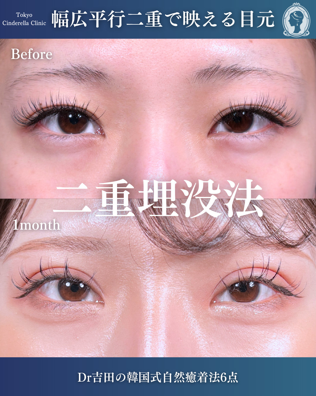 新宿院で行った二重埋没法の名医の吉田利之医師の症例写真