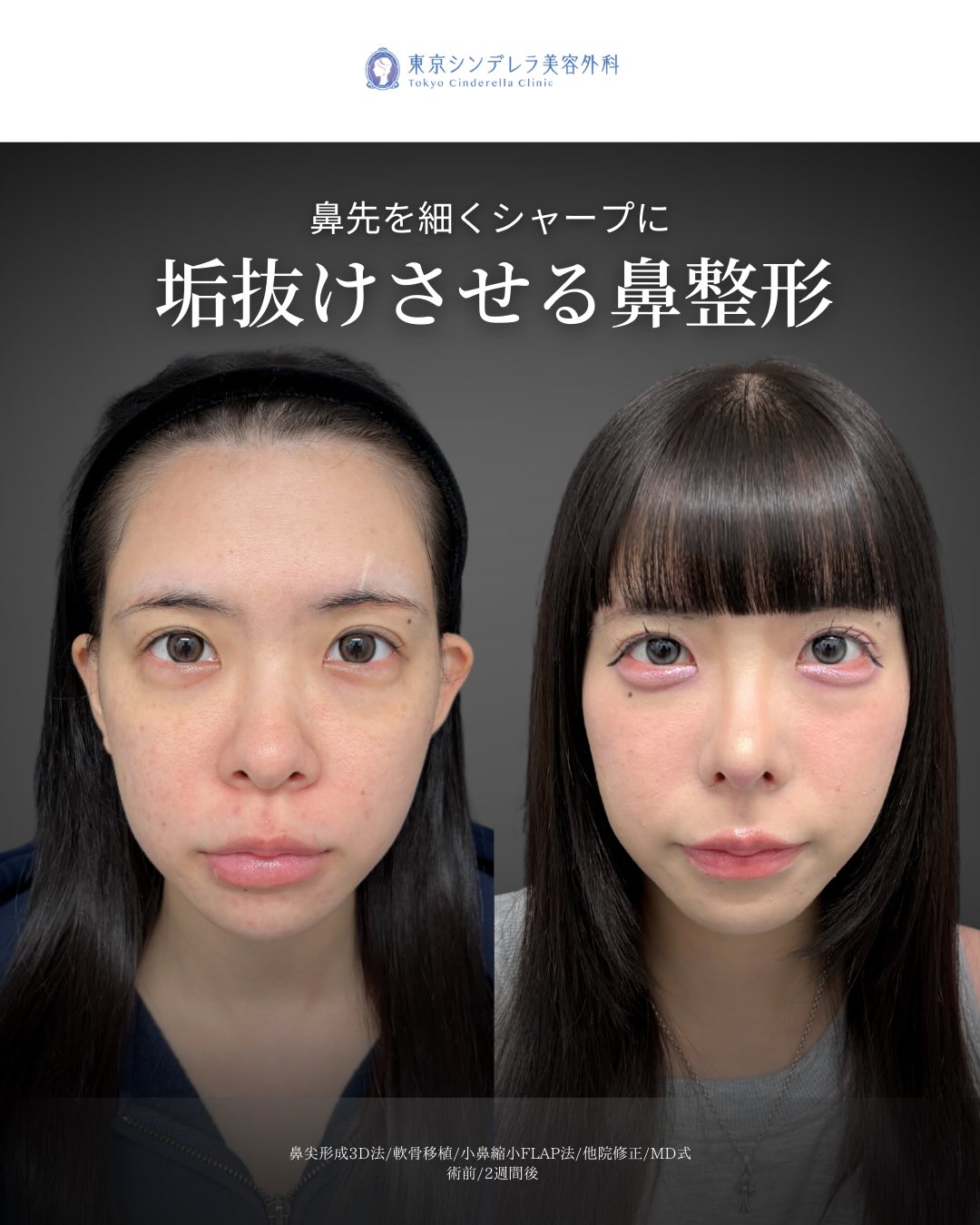 新宿院で行った鼻尖形成3D法と軟骨移植と小鼻縮小FLAP法と他院修正の2週間後の症例写真