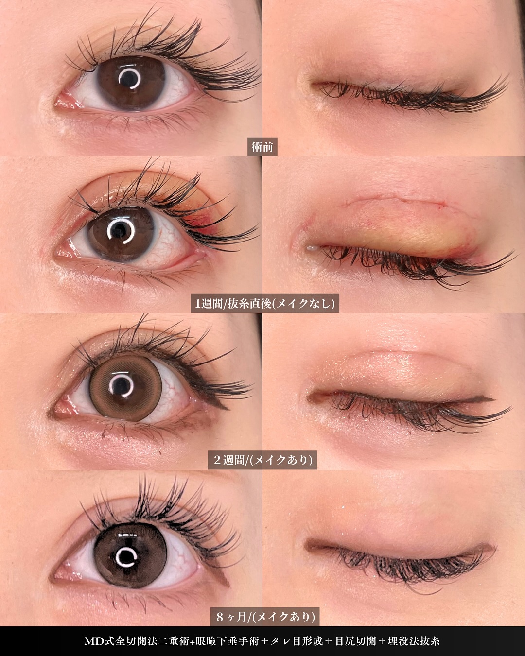 新宿院で行った二重整形で有名な吉原伯医師のMD式の全切開法二重術と眼瞼下垂手術と目尻切開とタレ目形成(結膜切開)と埋没法抜糸を行った8ヵ月後の症例写真
