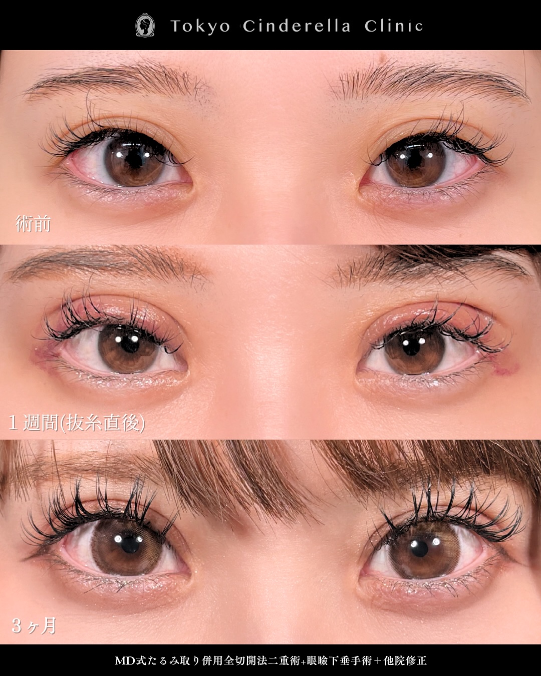 新宿院で行った二重整形で有名な吉原伯医師のMD式のたるみ取り併用全切開法二重術と眼瞼下垂手術と他院修正の3ヵ月までのダウンタイム症例写真