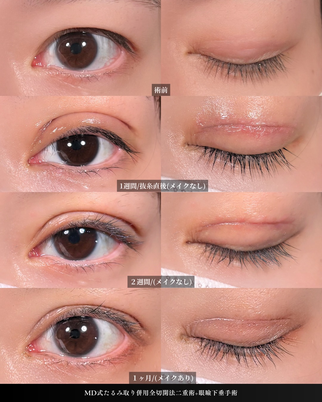 新宿院で行った吉原伯医師のMD式のたるみ取り併用全切開法二重術と眼瞼下垂手術の1ヵ月後までのダウンタイム症例写真