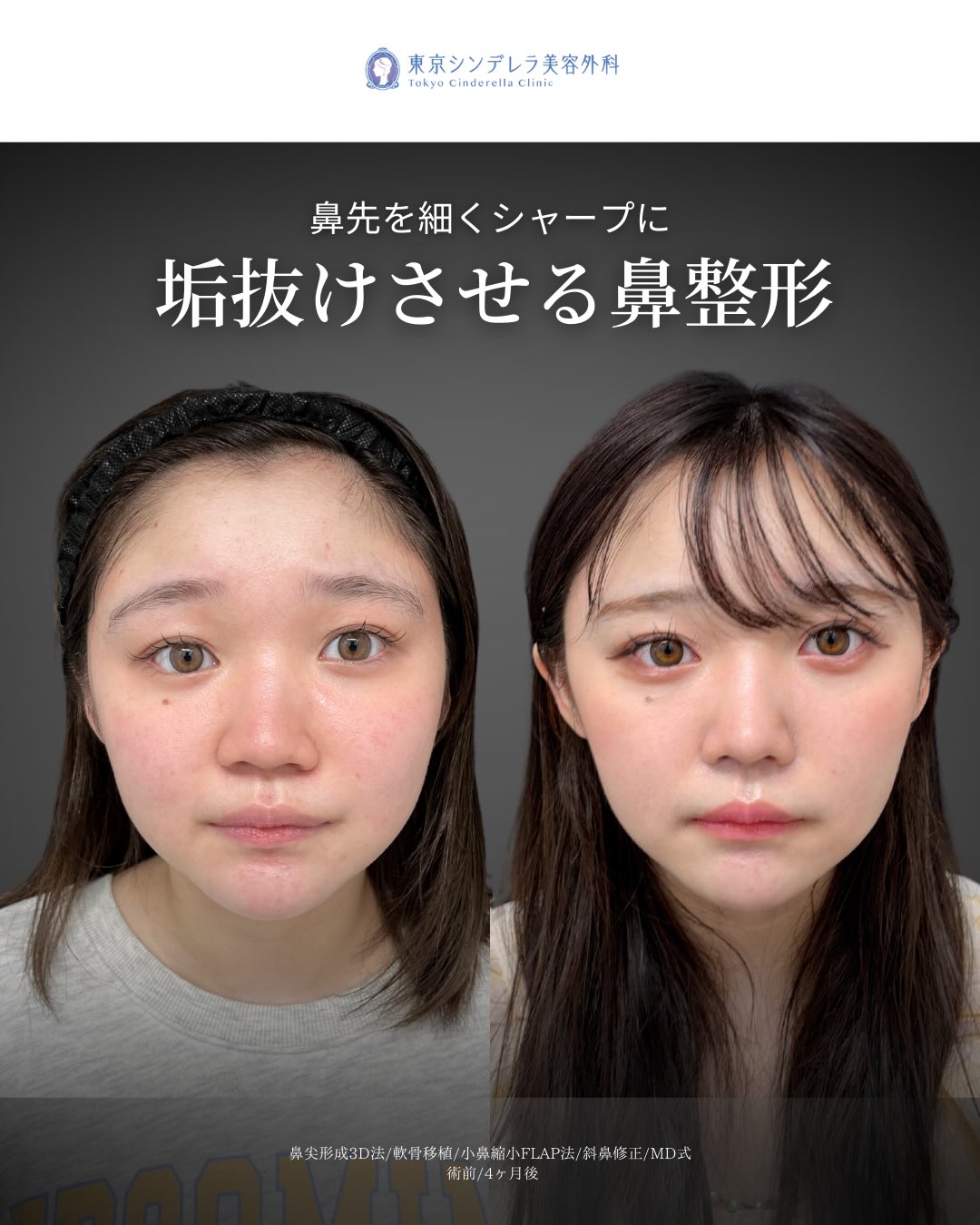 新宿院で行ったMD式の鼻尖形成3D法と軟骨移植と斜鼻修正と小鼻縮小FLAP法の4ヵ月後の症例写真