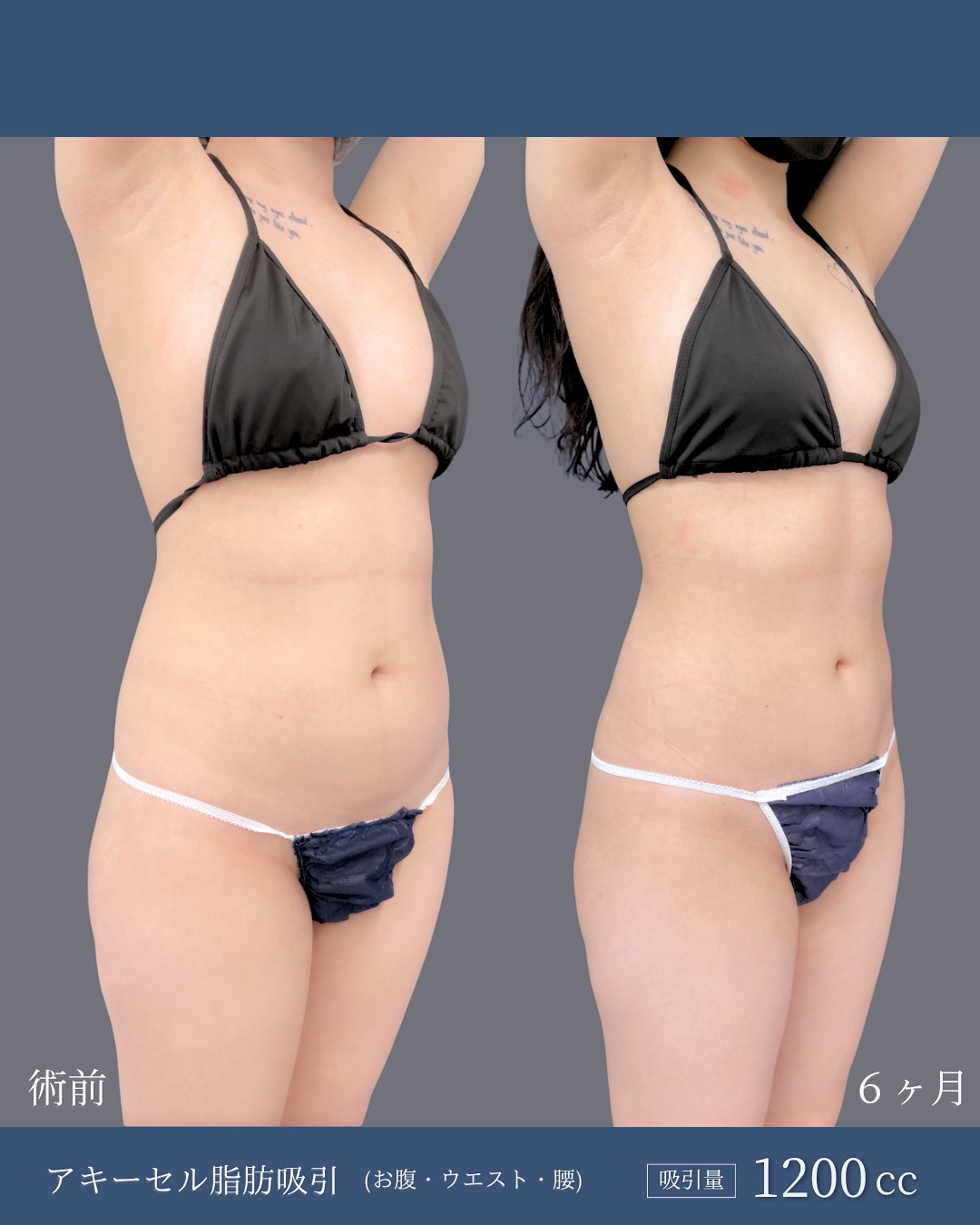 新宿院で行ったお腹とウエストと腰のアキーセル脂肪吸引の6ヶ月後の症例写真