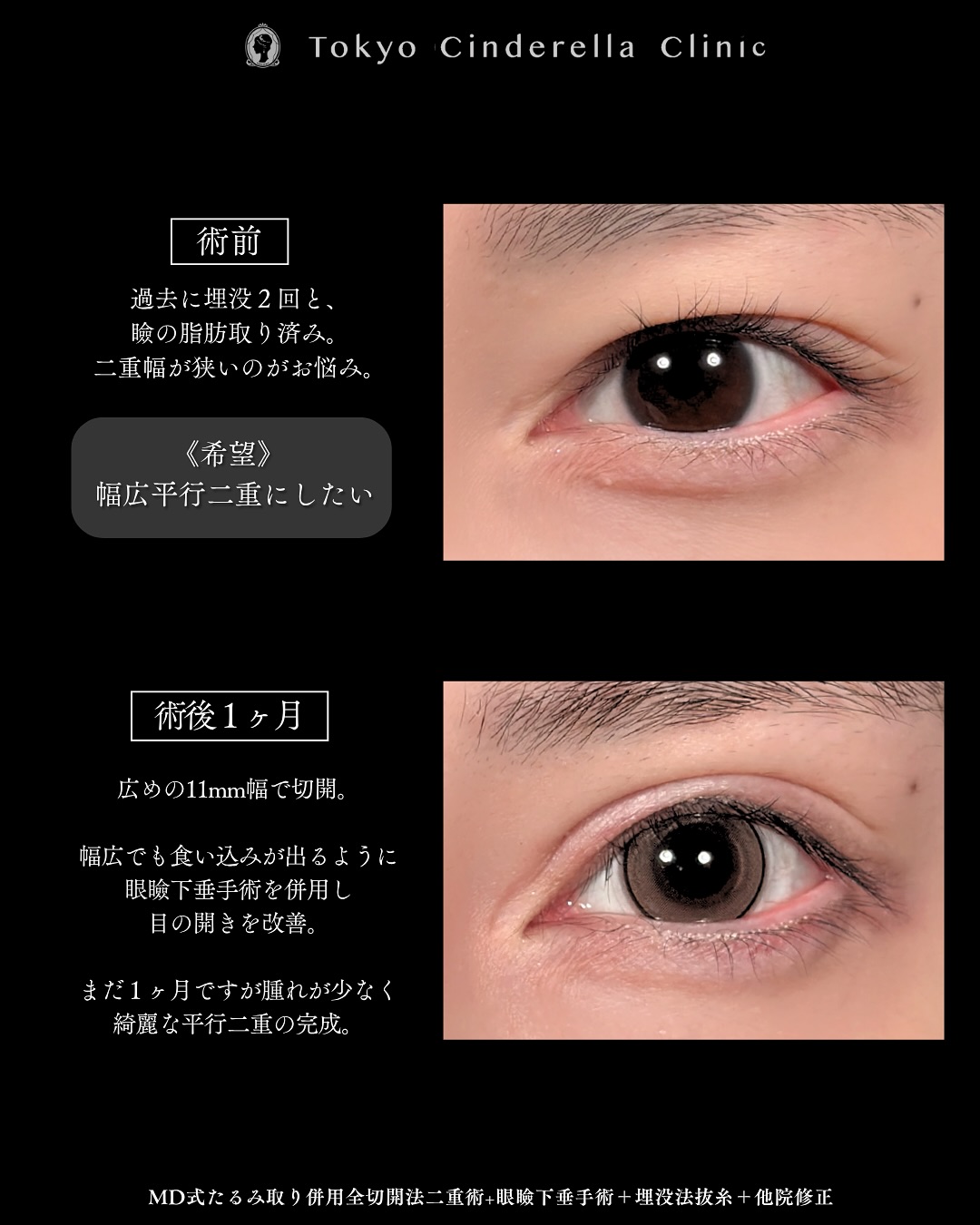 新宿院で行った二重整形で有名な吉原伯医師のMD式のたるみ取り併用全切開法二重術と眼瞼下垂手術と他院修正の1ヵ月症例写真