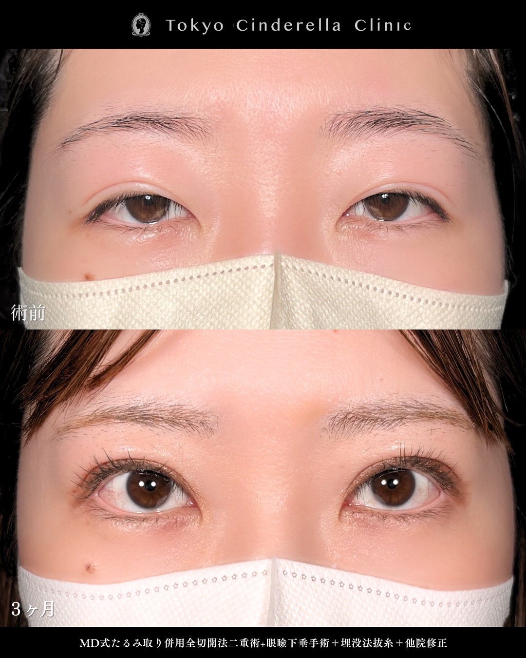 新宿院で行った二重整形で有名な吉原伯医師のMD式のたるみ取り併用全切開法二重術と眼瞼下垂手術と他院修正を行った3ヵ月までのダウンタイム症例写真