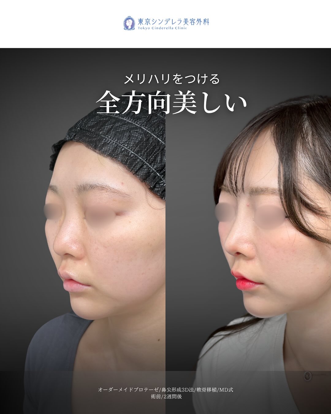 新宿院で行ったMD式鼻尖形成3D法と軟骨移植とオーダーメイドプロテーゼの2週間後の症例写真