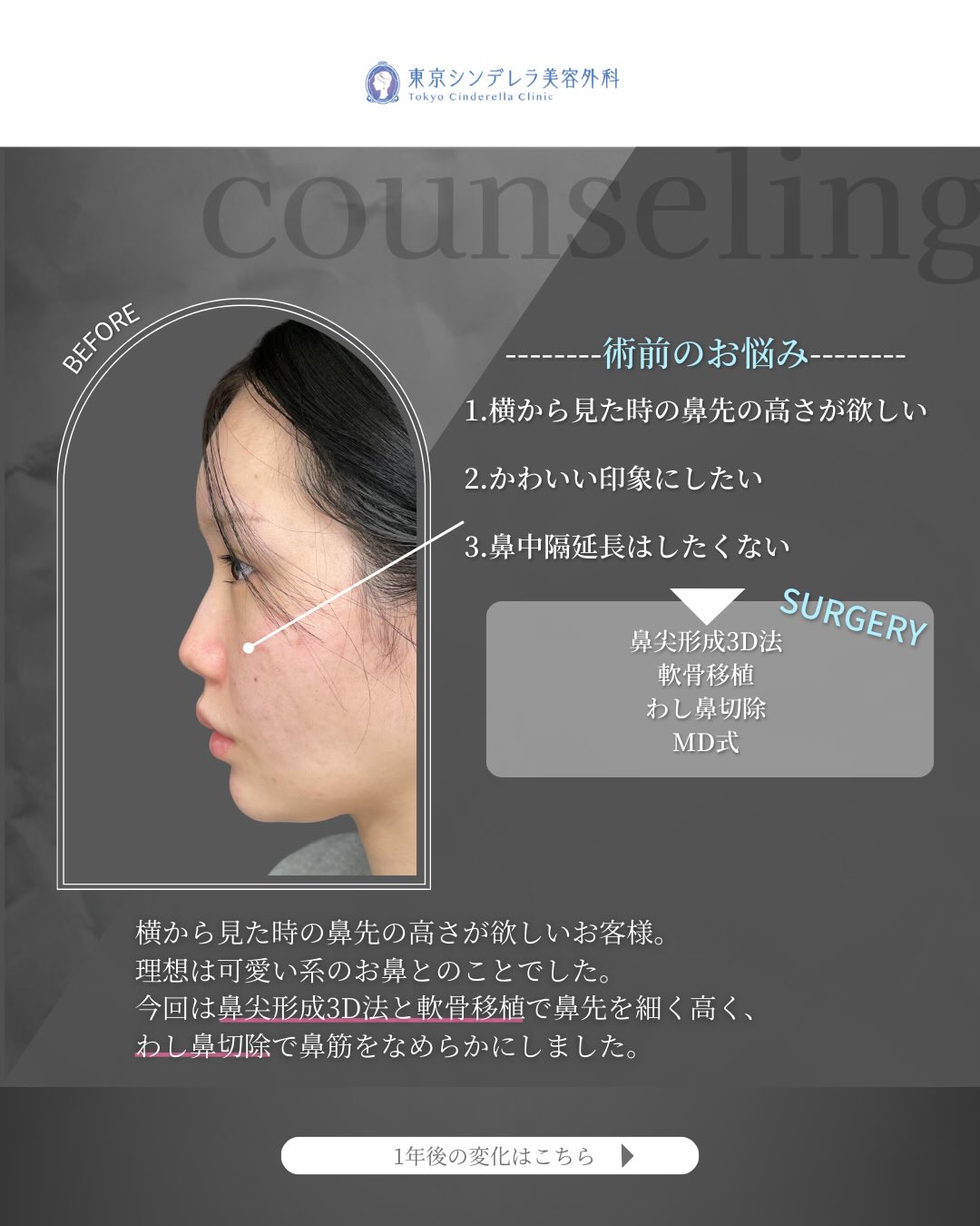 新宿院で行ったMD式の鼻尖形成3D法と軟骨移植とわし鼻切除との1年後の症例写真