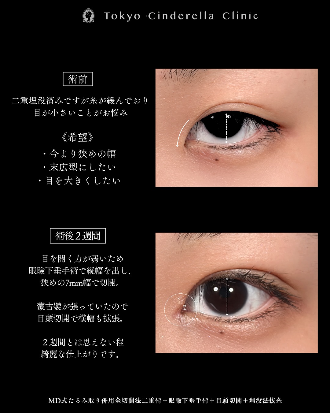 新宿院で行った二重整形で有名な吉原伯医師のMD式のたるみ取り併用全切開法二重術と眼瞼下垂手術と目頭切開の2週間までのダウンタイム症例写真