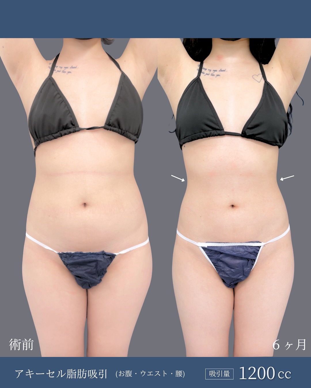 新宿院で行ったお腹とウエストと腰のアキーセル脂肪吸引の6ヶ月後の症例写真