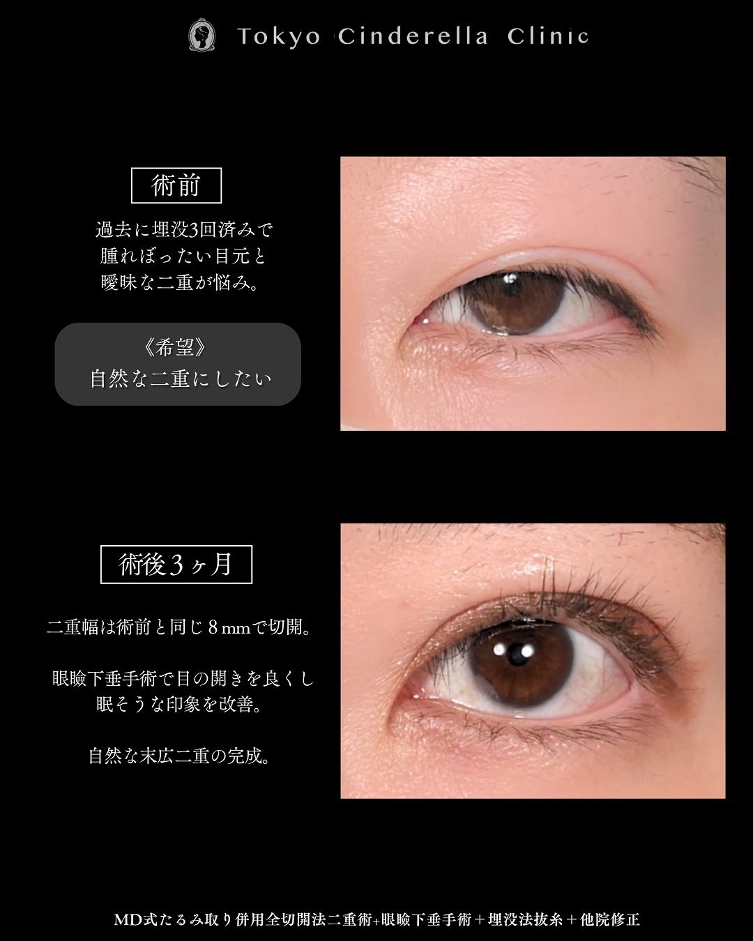 新宿院で行った二重整形で有名な吉原伯医師のMD式のたるみ取り併用全切開法二重術と眼瞼下垂手術と他院修正を行った3ヵ月までのダウンタイム症例写真