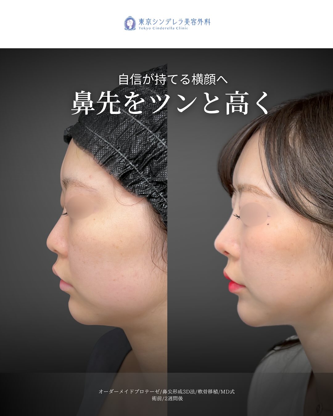 新宿院で行ったMD式鼻尖形成3D法と軟骨移植とオーダーメイドプロテーゼの2週間後の症例写真