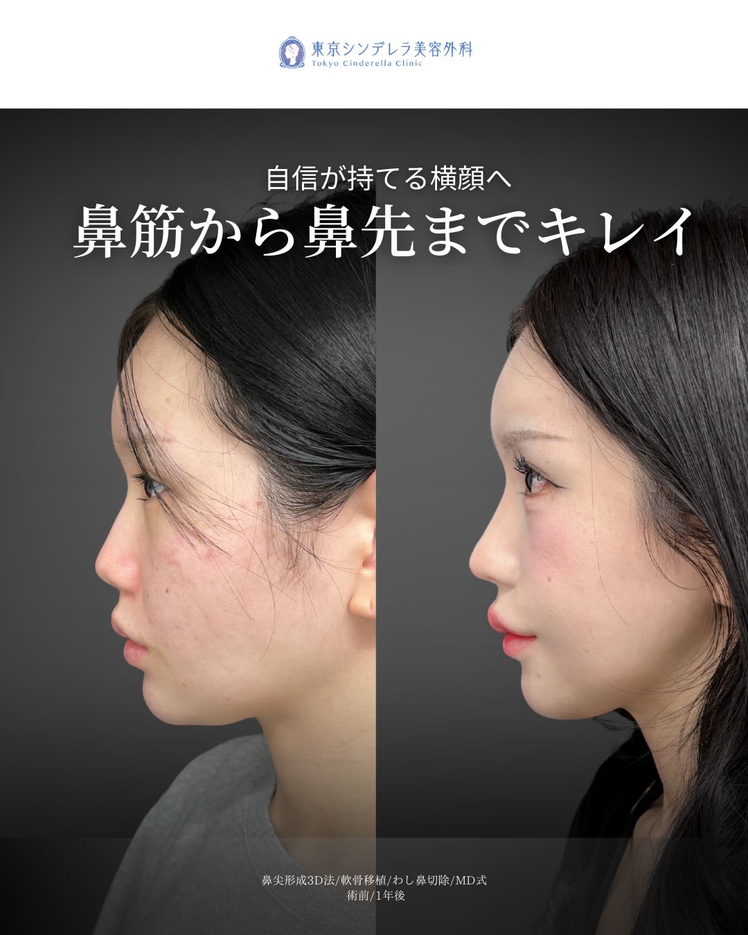 新宿院で行ったMD式の鼻尖形成3D法と軟骨移植とわし鼻切除との1年後の症例写真