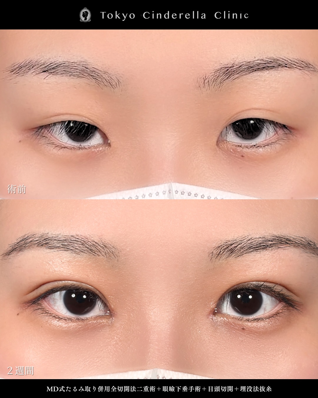 新宿院で行った二重整形で有名な吉原伯医師のMD式のたるみ取り併用全切開法二重術と眼瞼下垂手術と目頭切開の2週間までのダウンタイム症例写真