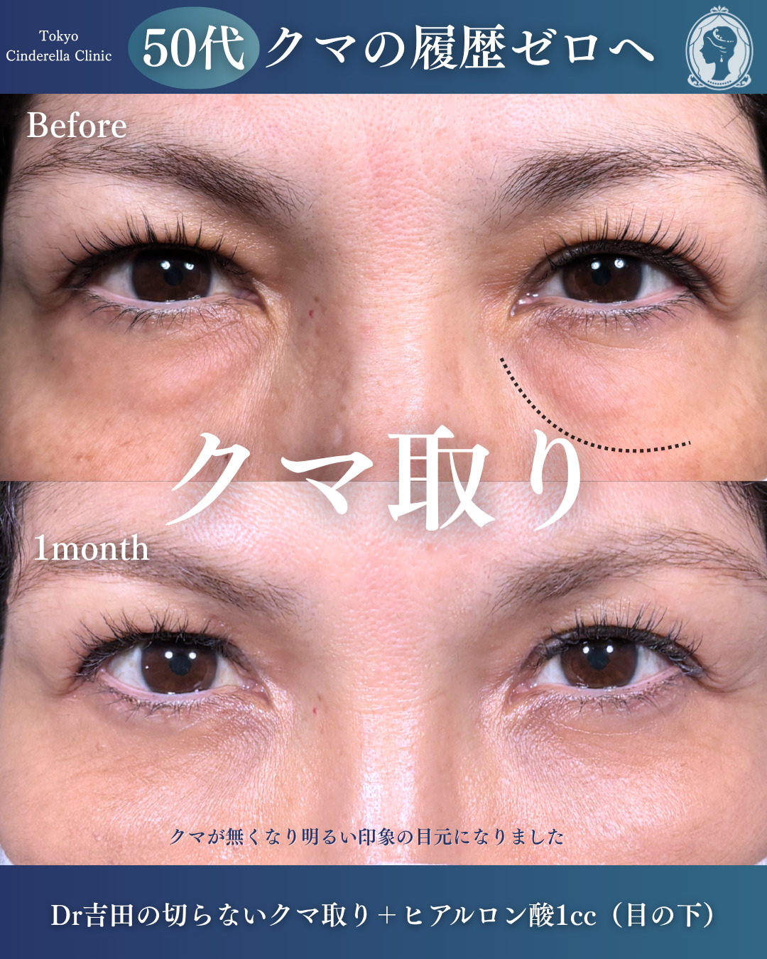 新宿院で行ったクマ治療の名医の吉田利之医師の症例写真