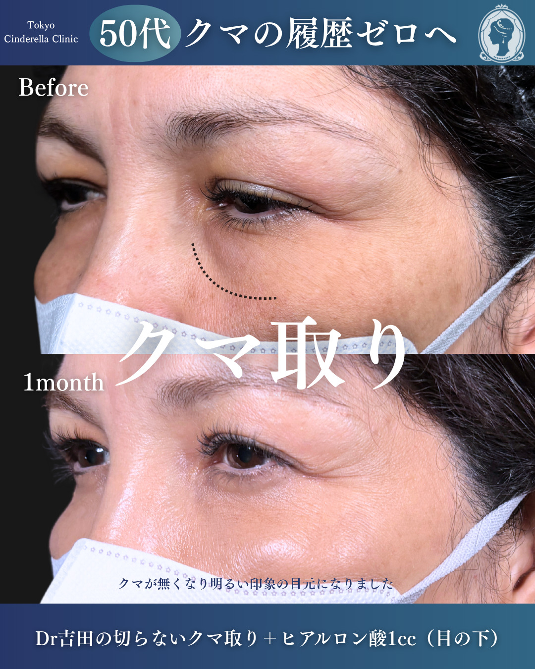 新宿院で行ったクマ治療の名医の吉田利之医師の症例写真