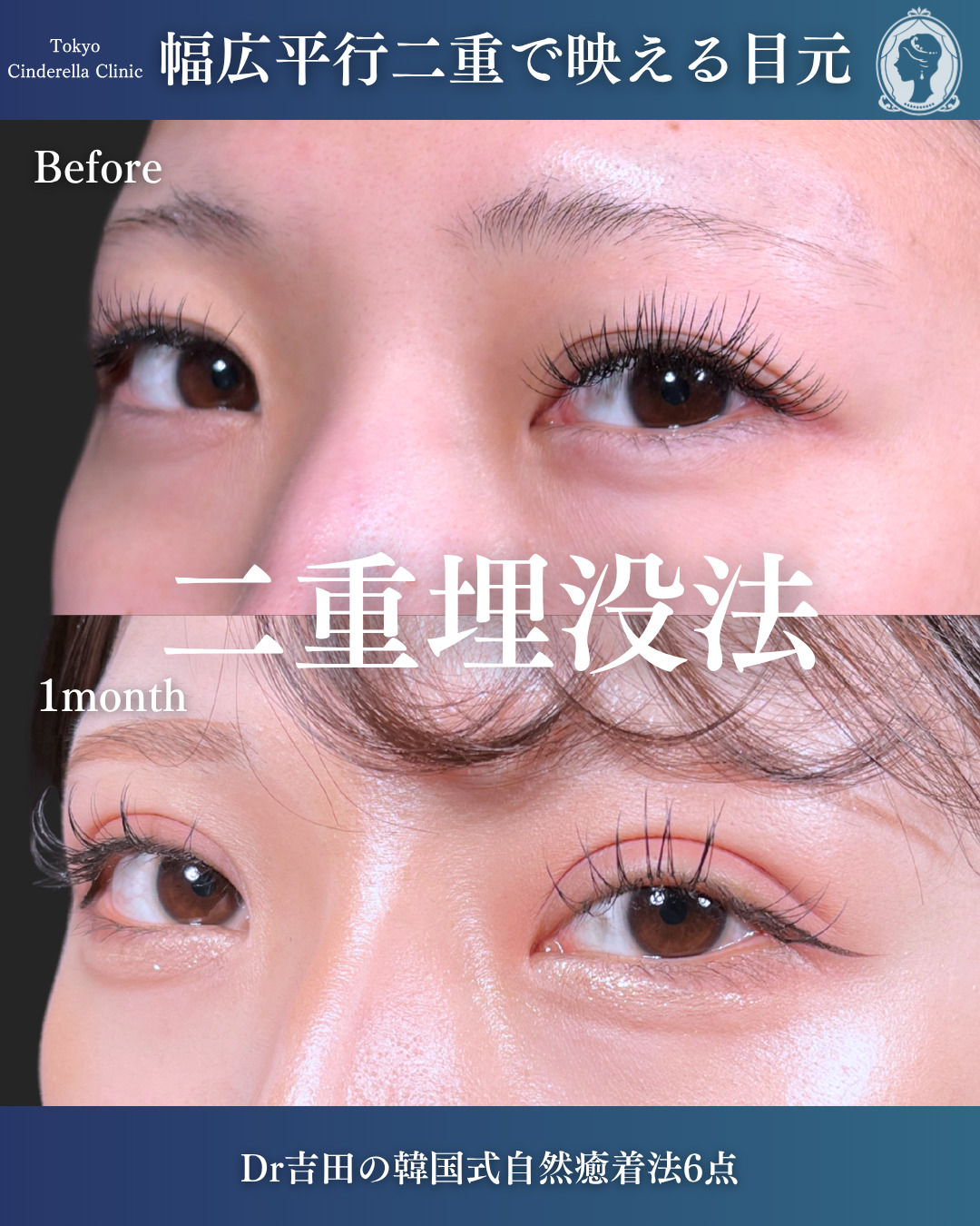 新宿院で行った二重埋没法の名医の吉田利之医師の症例写真