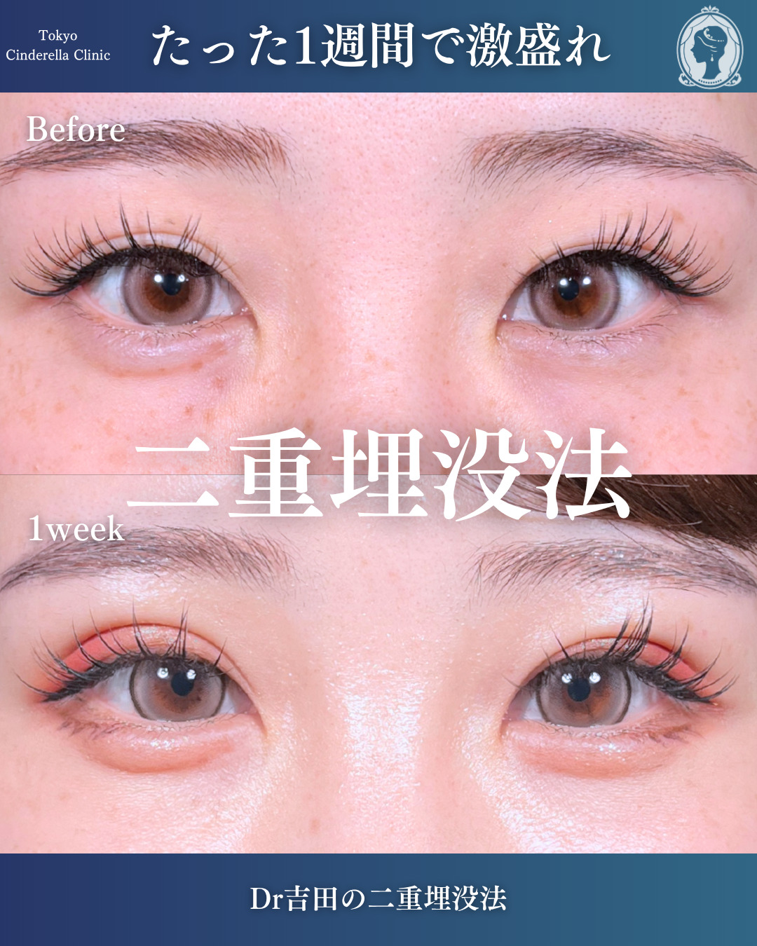 新宿院で行った二重埋没法の名医の吉田利之医師の症例写真