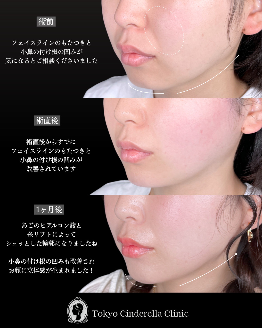 池袋院で行ったクイックリフト8本とヒアルロン酸（ほうれい線基部・あご）整形で有名な名医の石井達也の症例写真