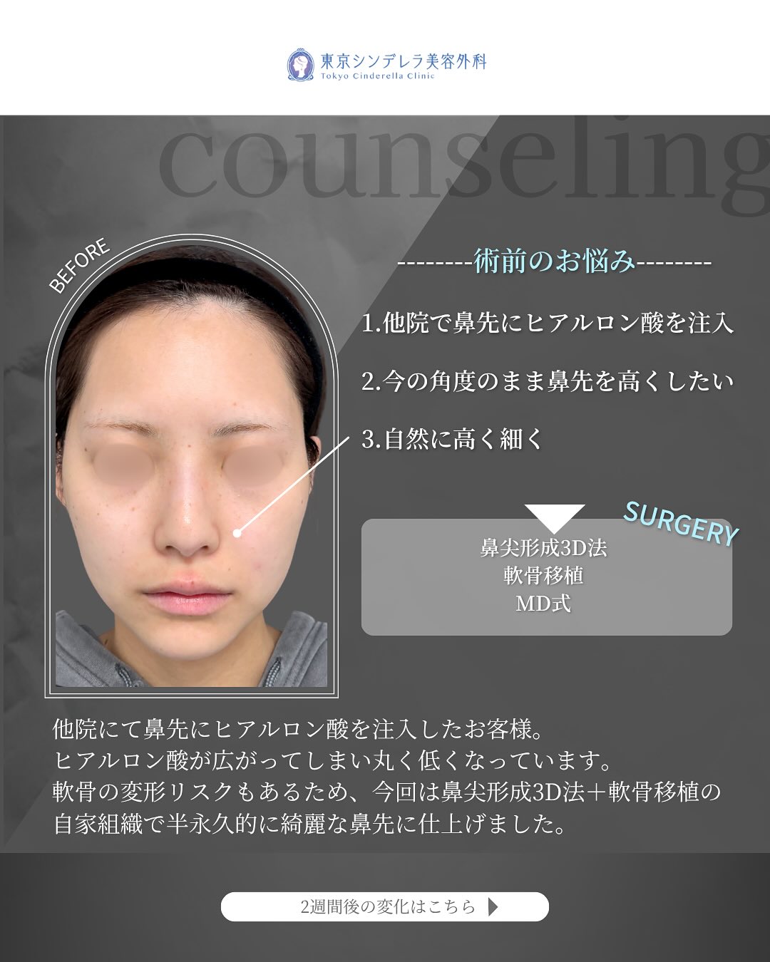 新宿院で行った鼻尖形成3D法と軟骨移植の2週間後の症例写真