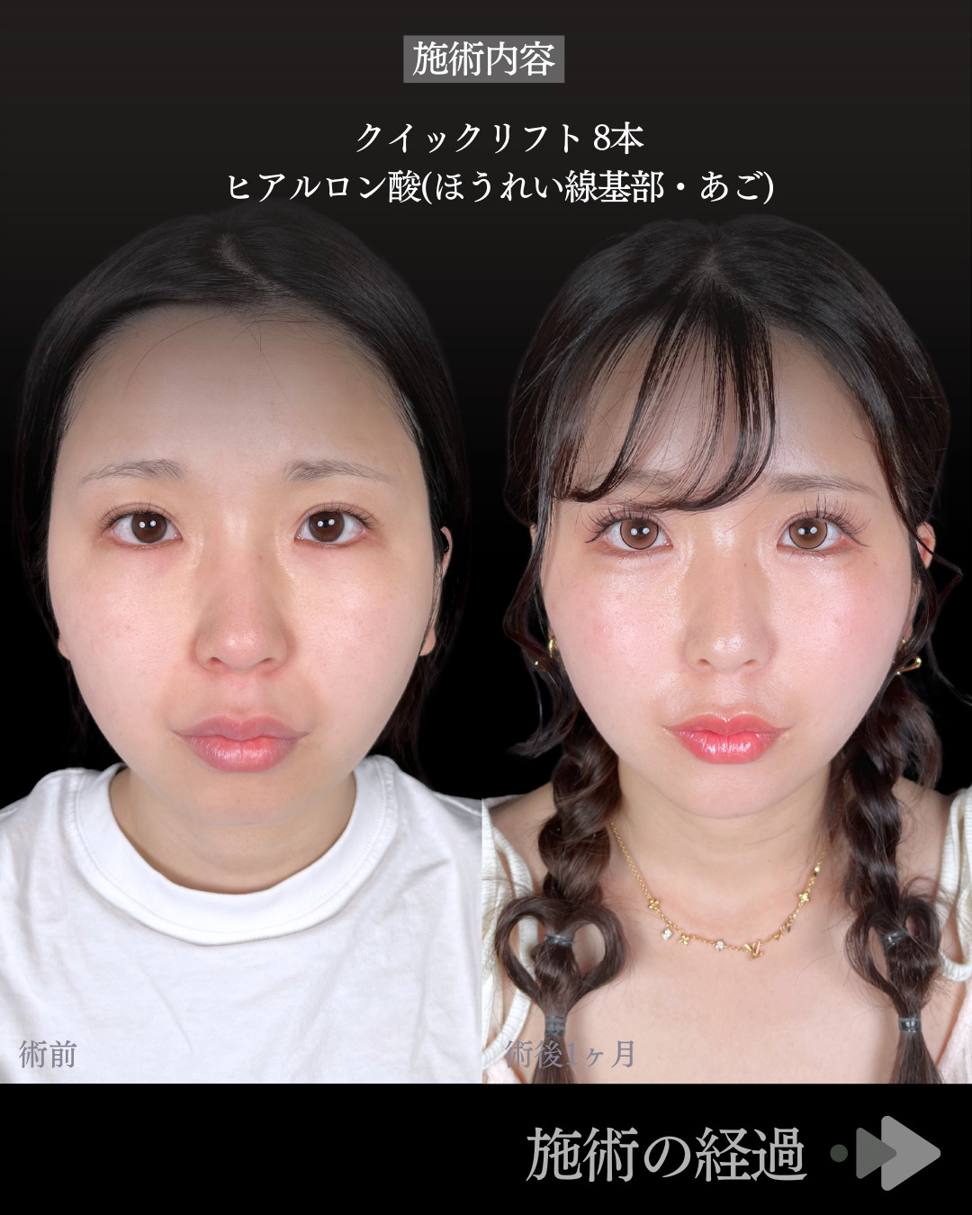 池袋院で行ったクイックリフト8本とヒアルロン酸（ほうれい線基部・あご）整形で有名な名医の石井達也の症例写真