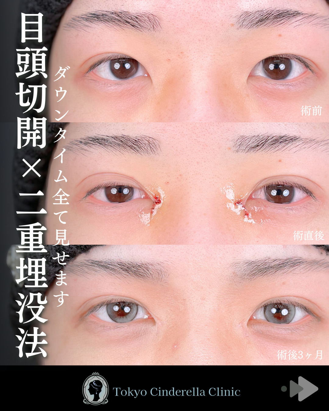 池袋院で行った目頭切開とクイックシンデレラ・ダブル整形で有名な名医の石井達也の症例写真