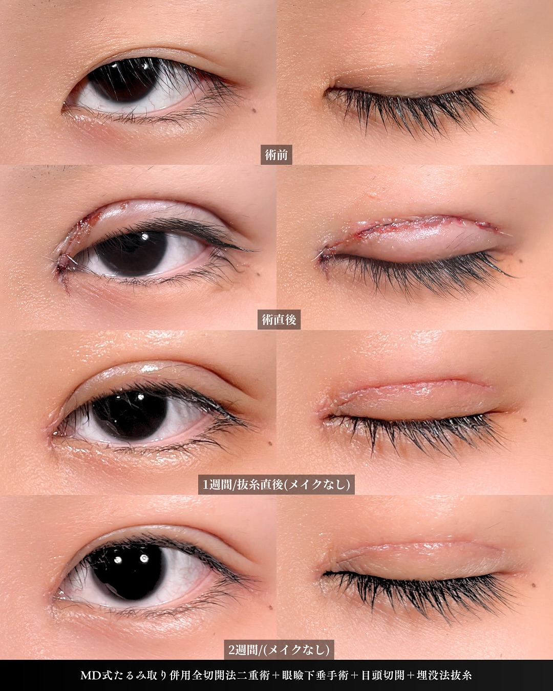 新宿院で行った二重整形で有名な吉原伯医師のMD式のたるみ取り併用全切開法二重術と眼瞼下垂手術と目頭切開の2週間までのダウンタイム症例写真