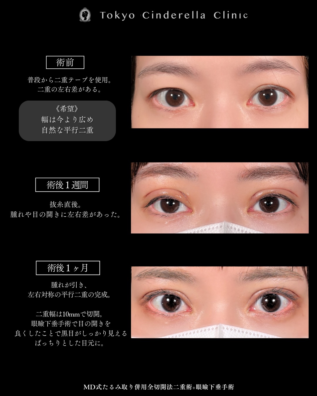 新宿院で行った吉原伯医師のMD式のたるみ取り併用全切開法二重術と眼瞼下垂手術の1ヵ月後までのダウンタイム症例写真