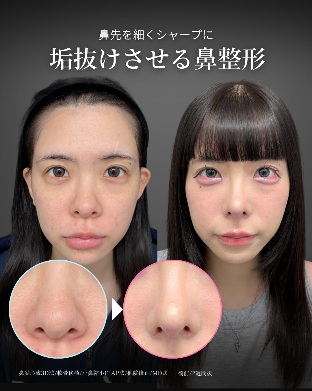 新宿院で行った鼻尖形成3D法と軟骨移植と小鼻縮小FLAP法と他院修正の2週間後の症例写真